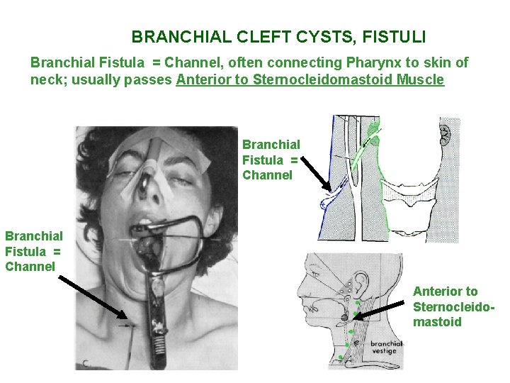 BRANCHIAL CLEFT CYSTS, FISTULI Branchial Fistula = Channel, often connecting Pharynx to skin of BRANCHIAL CLEFT CYSTS, FISTULI Branchial Fistula = Channel, often connecting Pharynx to skin of