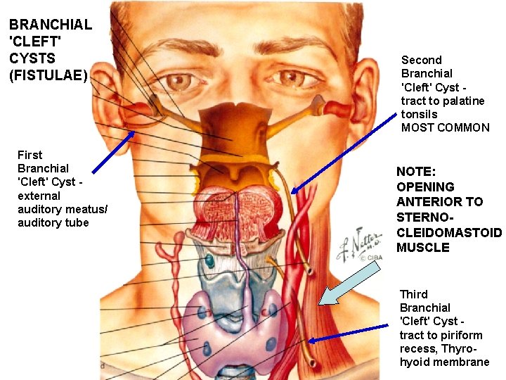 BRANCHIAL 'CLEFT' CYSTS (FISTULAE) First Branchial 'Cleft' Cyst external auditory meatus/ auditory tube Second BRANCHIAL 'CLEFT' CYSTS (FISTULAE) First Branchial 'Cleft' Cyst external auditory meatus/ auditory tube Second