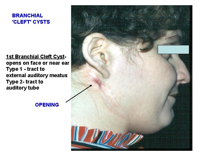 BRANCHIAL 'CLEFT' CYSTS 1 st Branchial Cleft Cystopens on face or near Type 1 BRANCHIAL 'CLEFT' CYSTS 1 st Branchial Cleft Cystopens on face or near Type 1