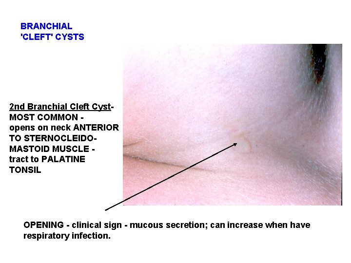 BRANCHIAL 'CLEFT' CYSTS 2 nd Branchial Cleft Cyst. MOST COMMON opens on neck ANTERIOR BRANCHIAL 'CLEFT' CYSTS 2 nd Branchial Cleft Cyst. MOST COMMON opens on neck ANTERIOR