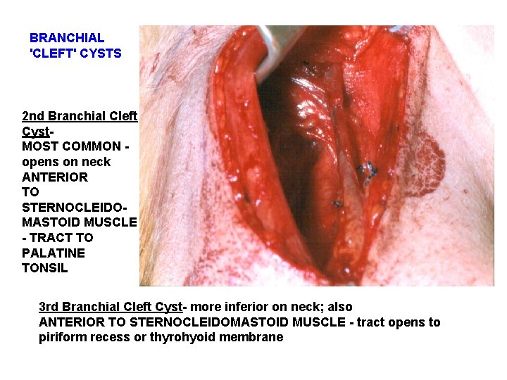 BRANCHIAL 'CLEFT' CYSTS 2 nd Branchial Cleft Cyst. MOST COMMON opens on neck ANTERIOR BRANCHIAL 'CLEFT' CYSTS 2 nd Branchial Cleft Cyst. MOST COMMON opens on neck ANTERIOR