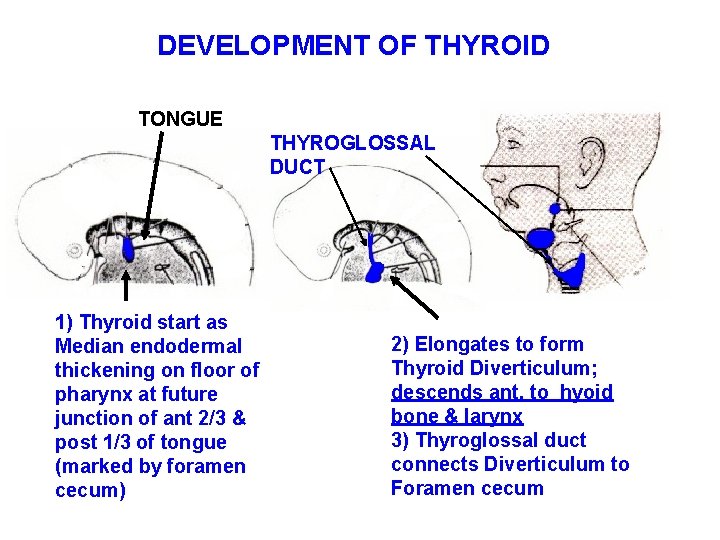 DEVELOPMENT OF THYROID TONGUE THYROGLOSSAL DUCT 1) Thyroid start as Median endodermal thickening on