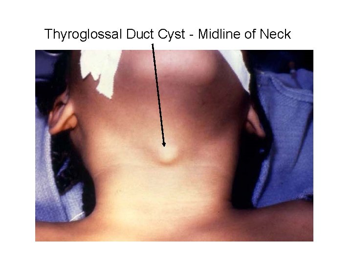 Thyroglossal Duct Cyst - Midline of Neck 