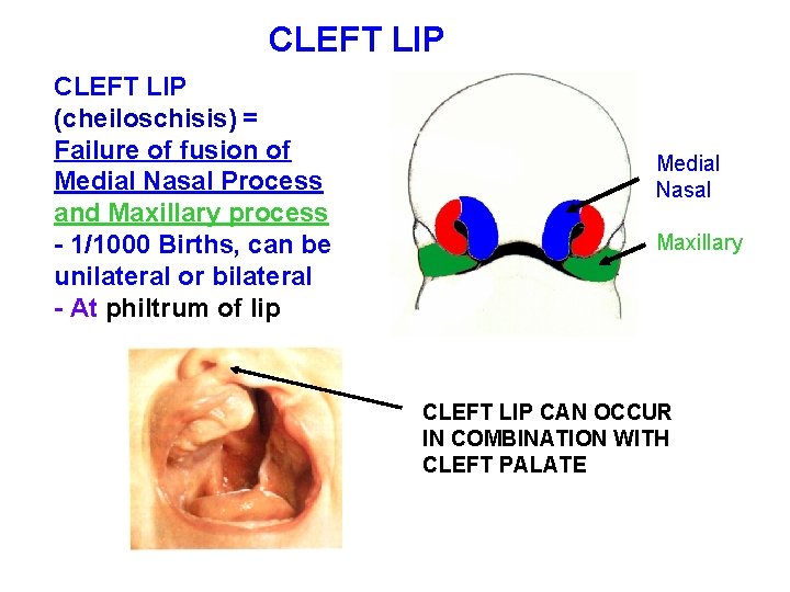 CLEFT LIP (cheiloschisis) = Failure of fusion of Medial Nasal Process and Maxillary process CLEFT LIP (cheiloschisis) = Failure of fusion of Medial Nasal Process and Maxillary process