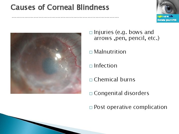 Causes of Corneal Blindness ---------------------------------- � Light up a Life Donate your EYES Injuries