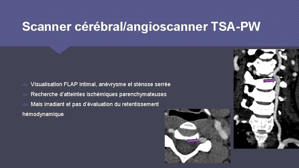 Scanner cérébral/angioscanner TSA-PW Visualisation FLAP intimal, anévrysme et sténose serrée Recherche d’atteintes ischémiques parenchymateuses