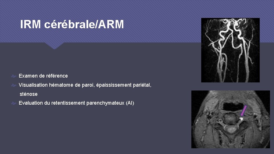 IRM cérébrale/ARM Examen de référence Visualisation hématome de paroi, épaississement pariétal, sténose Evaluation du