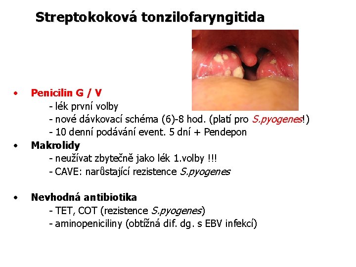 Streptokoková tonzilofaryngitida • • • Penicilin G / V - lék první volby -
