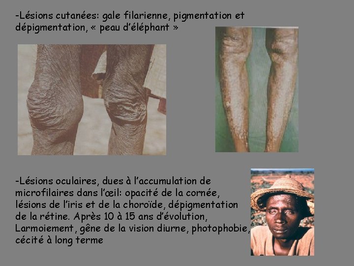 -Lésions cutanées: gale filarienne, pigmentation et dépigmentation, « peau d’éléphant » -Lésions oculaires, dues