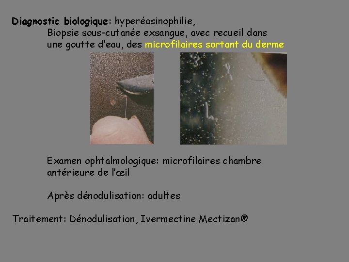 Diagnostic biologique: hyperéosinophilie, Biopsie sous-cutanée exsangue, avec recueil dans une goutte d’eau, des microfilaires