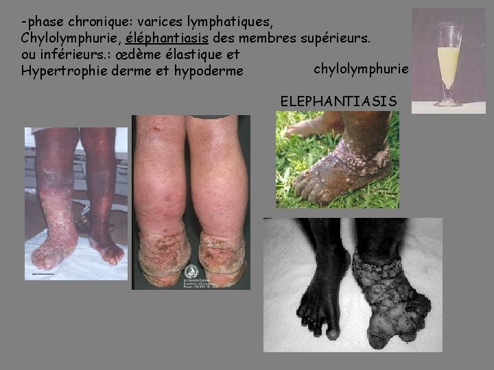 -phase chronique: varices lymphatiques, Chylolymphurie, éléphantiasis des membres supérieurs. ou inférieurs. : œdème élastique