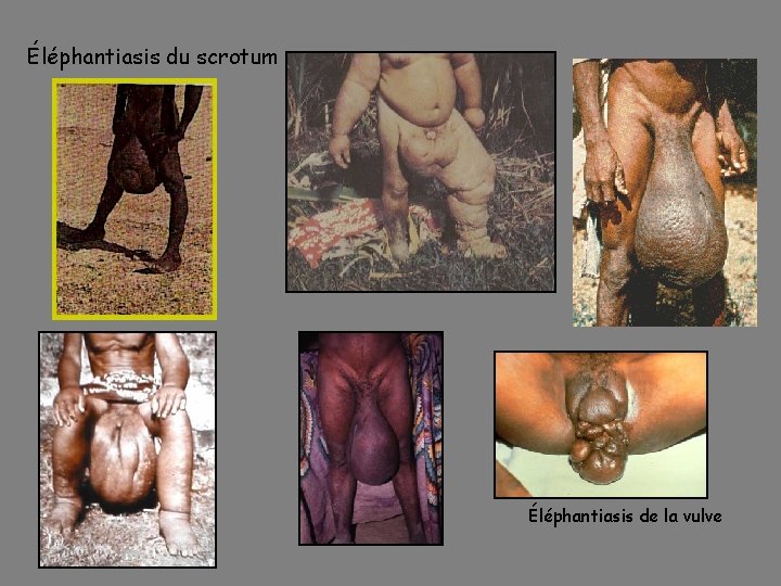 Éléphantiasis du scrotum Éléphantiasis de la vulve 