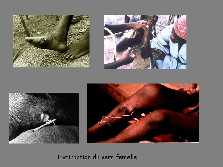 Extirpation du vers femelle 