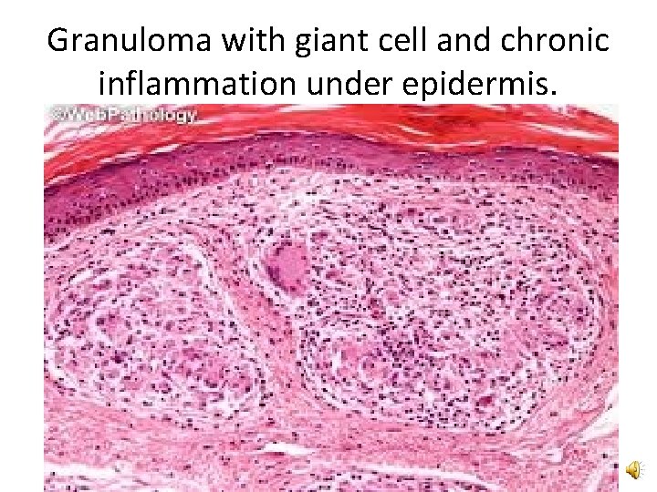 Granuloma with giant cell and chronic inflammation under epidermis. 