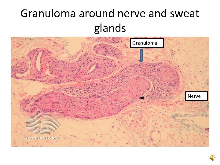 Granuloma around nerve and sweat glands Granuloma Nerve 