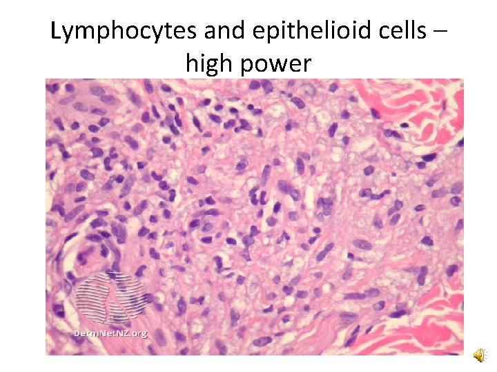 Lymphocytes and epithelioid cells – high power 