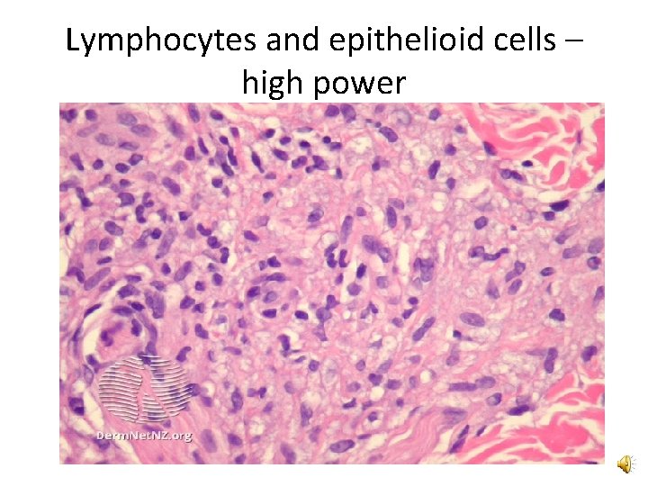 Lymphocytes and epithelioid cells – high power 