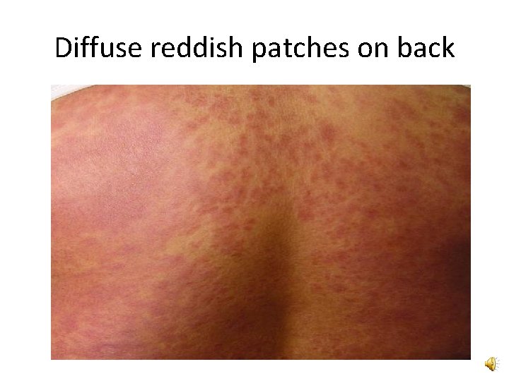 Diffuse reddish patches on back 