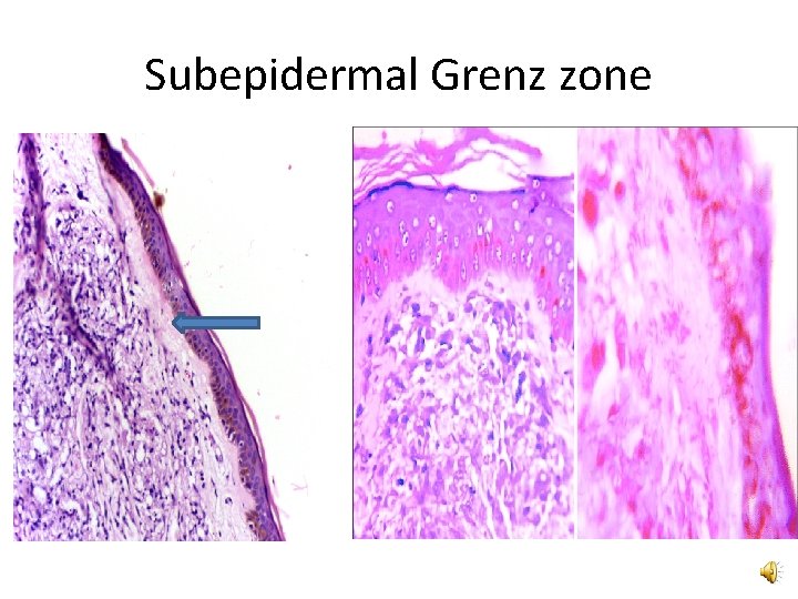 Subepidermal Grenz zone 