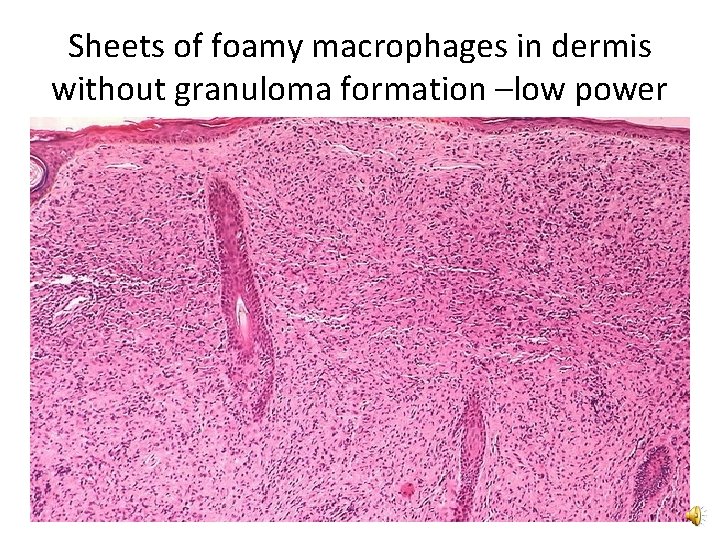 Sheets of foamy macrophages in dermis without granuloma formation –low power 
