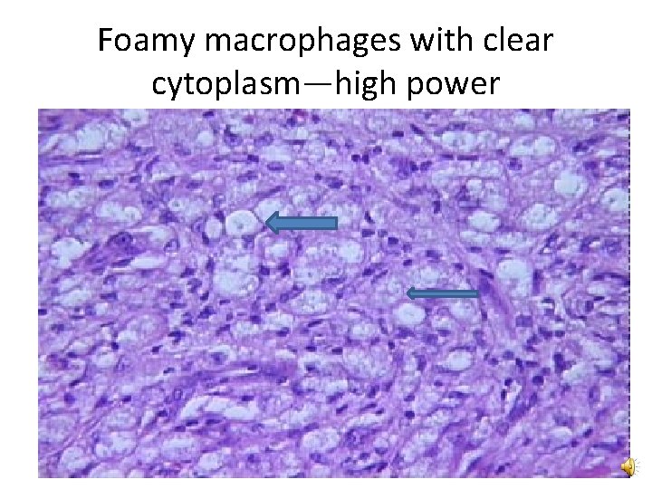 Foamy macrophages with clear cytoplasm—high power 