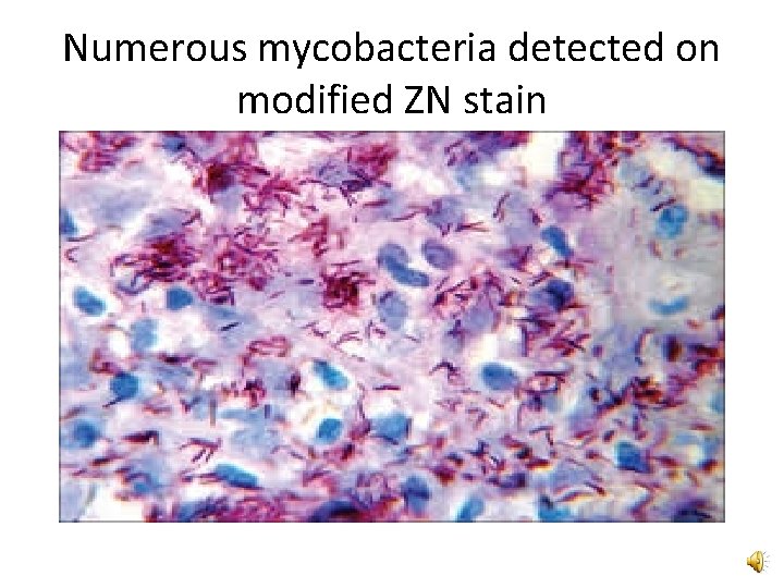 Numerous mycobacteria detected on modified ZN stain 