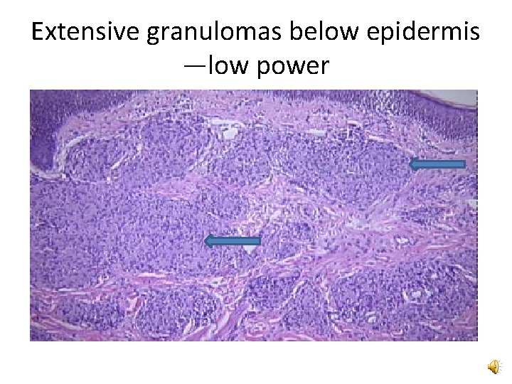 Extensive granulomas below epidermis —low power 