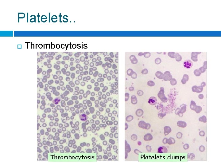 Platelets. . Thrombocytosis 