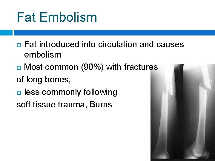 Fat Embolism Fat introduced into circulation and causes embolism Most common (90%) with fractures