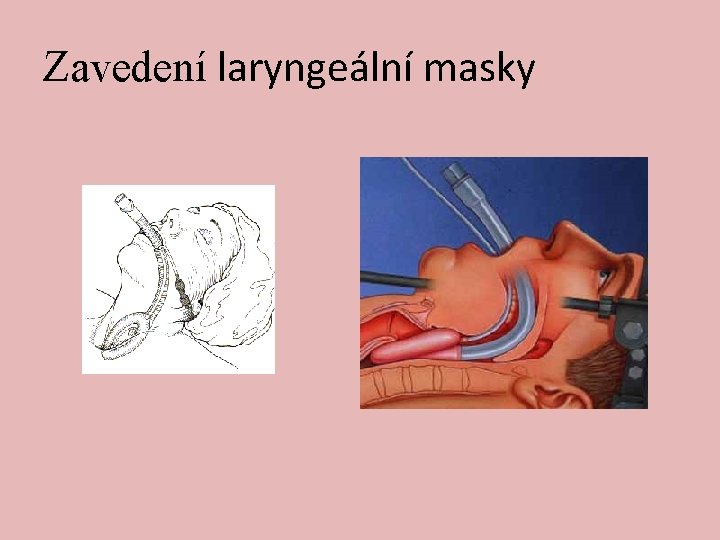 Zavedení laryngeální masky 