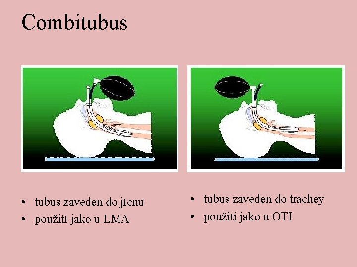 Combitubus • tubus zaveden do jícnu • použití jako u LMA • tubus zaveden