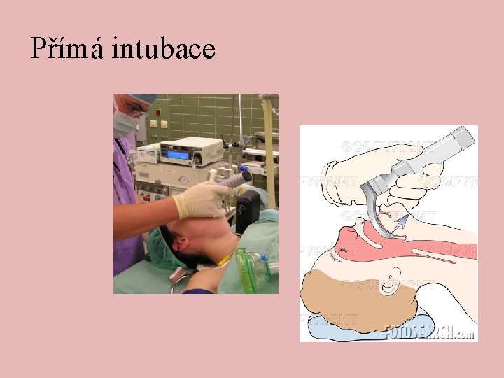 Přímá intubace 
