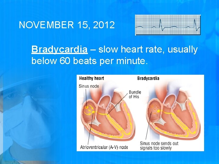 NOVEMBER 15, 2012 Bradycardia – slow heart rate, usually below 60 beats per minute.