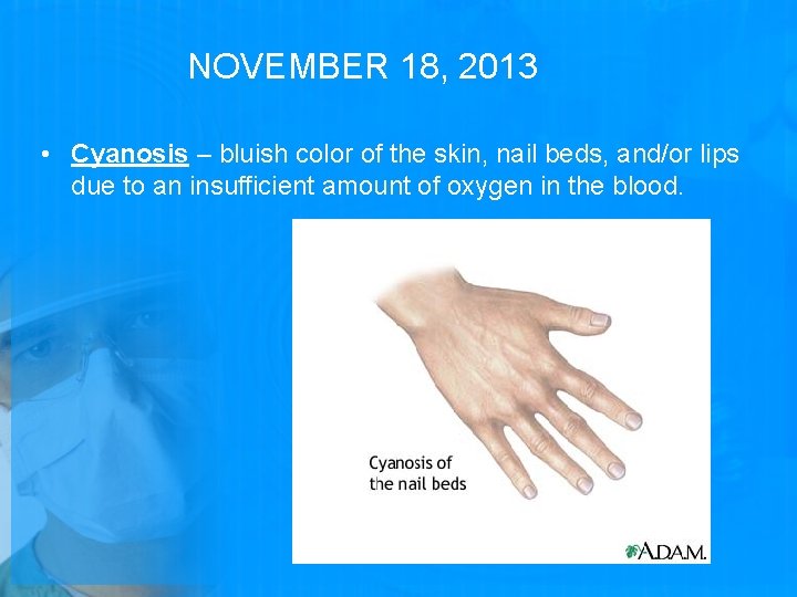 NOVEMBER 18, 2013 • Cyanosis – bluish color of the skin, nail beds, and/or