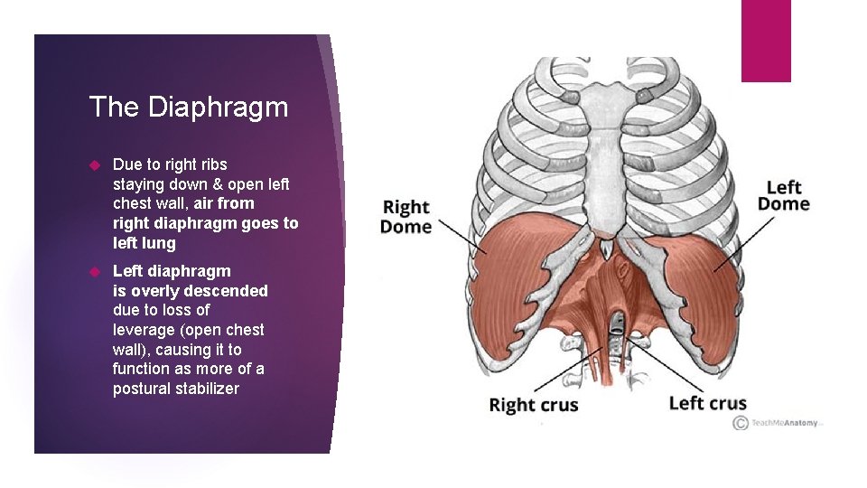 The Diaphragm Due to right ribs staying down & open left chest wall, air