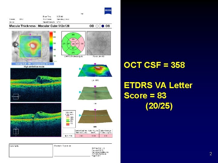 OCT CSF = 358 ETDRS VA Letter Score = 83 (20/25) 2 