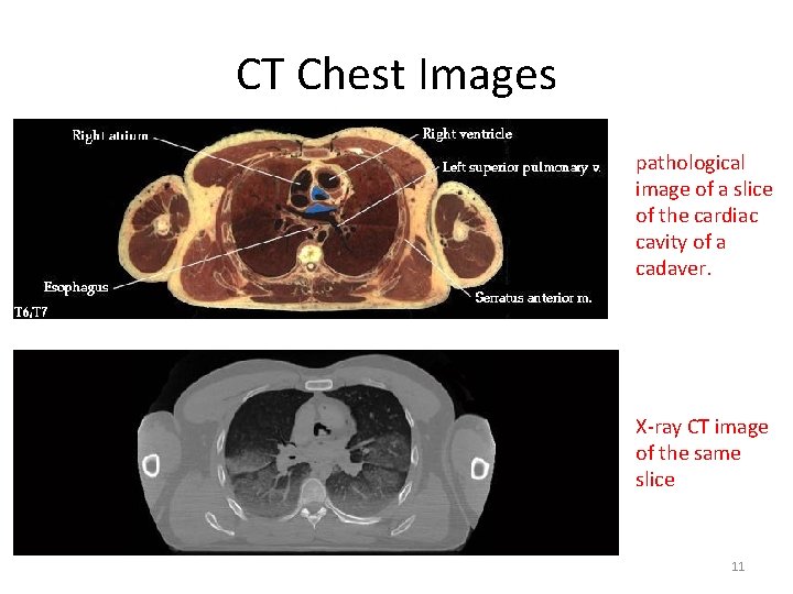 CT Chest Images pathological image of a slice of the cardiac cavity of a CT Chest Images pathological image of a slice of the cardiac cavity of a