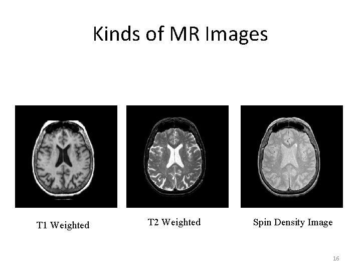 Kinds of MR Images T 1 Weighted T 2 Weighted Spin Density Image 16 Kinds of MR Images T 1 Weighted T 2 Weighted Spin Density Image 16