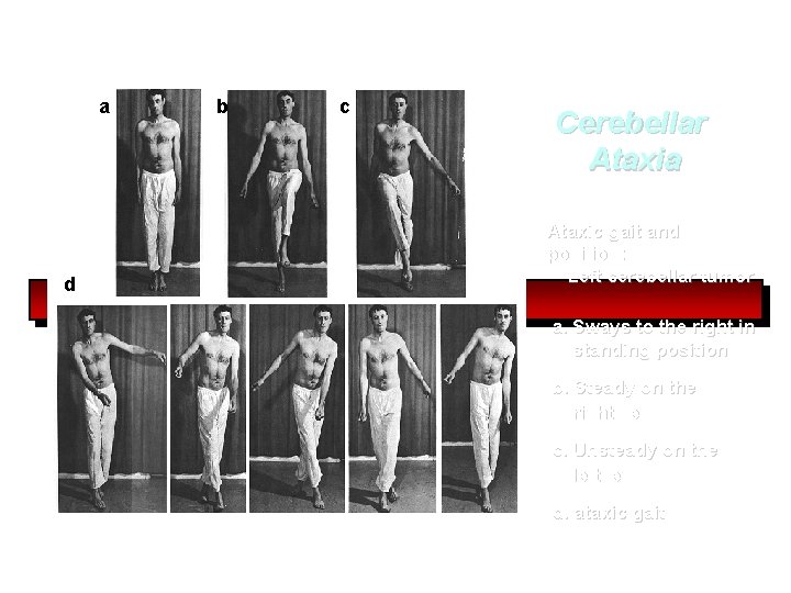 a d b c Cerebellar Ataxia Ataxic gait and position: Left cerebellar tumor a.