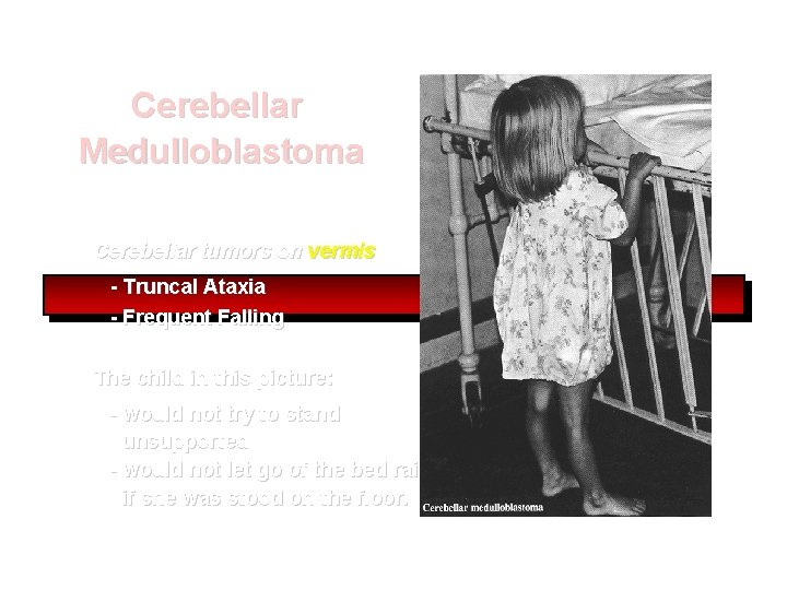 Cerebellar Medulloblastoma Cerebellar tumors on vermis - Truncal Ataxia - Frequent Falling The child