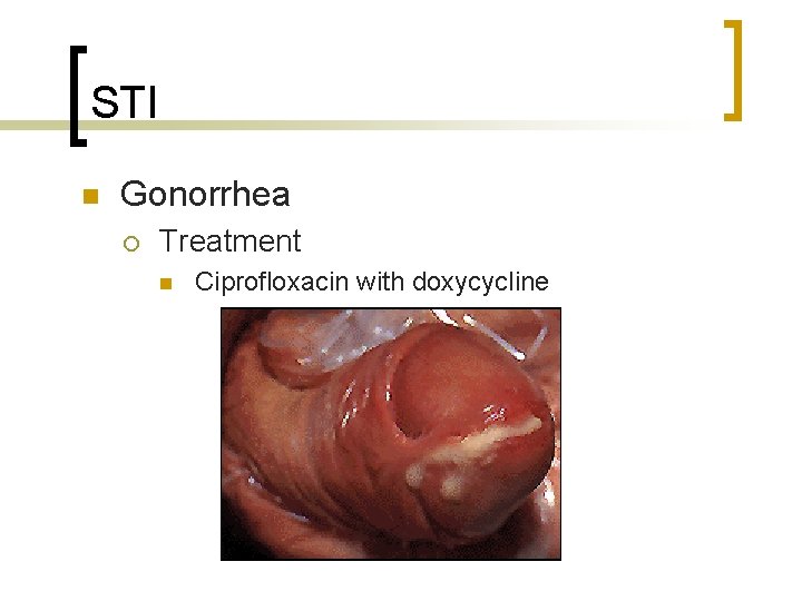 STI n Gonorrhea ¡ Treatment n Ciprofloxacin with doxycycline 