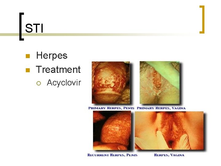 STI n n Herpes Treatment ¡ Acyclovir 
