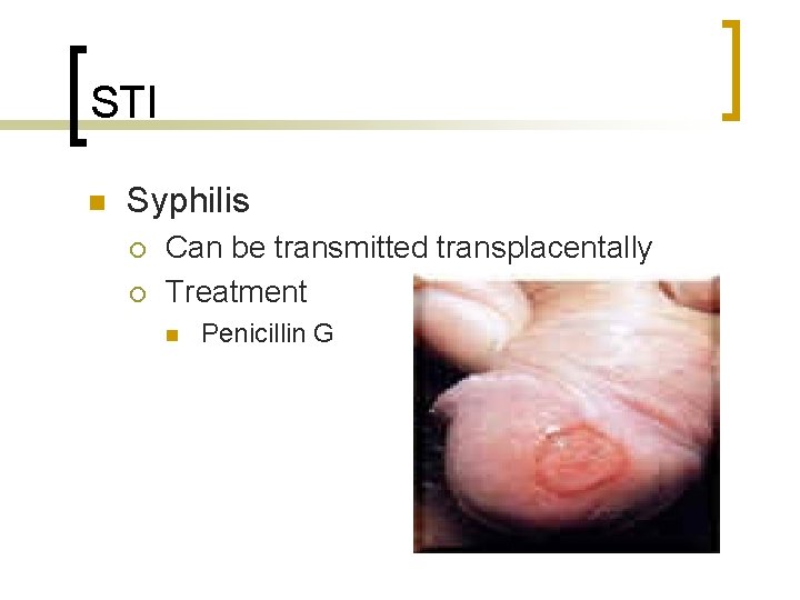 STI n Syphilis ¡ ¡ Can be transmitted transplacentally Treatment n Penicillin G 