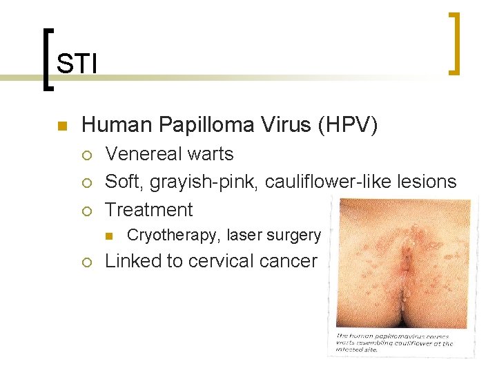 STI n Human Papilloma Virus (HPV) ¡ ¡ ¡ Venereal warts Soft, grayish-pink, cauliflower-like