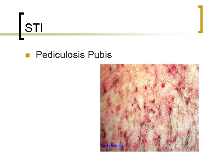 STI n Pediculosis Pubis 