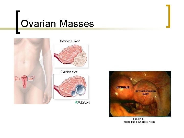 Ovarian Masses 