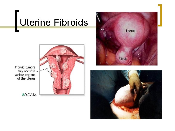 Uterine Fibroids 