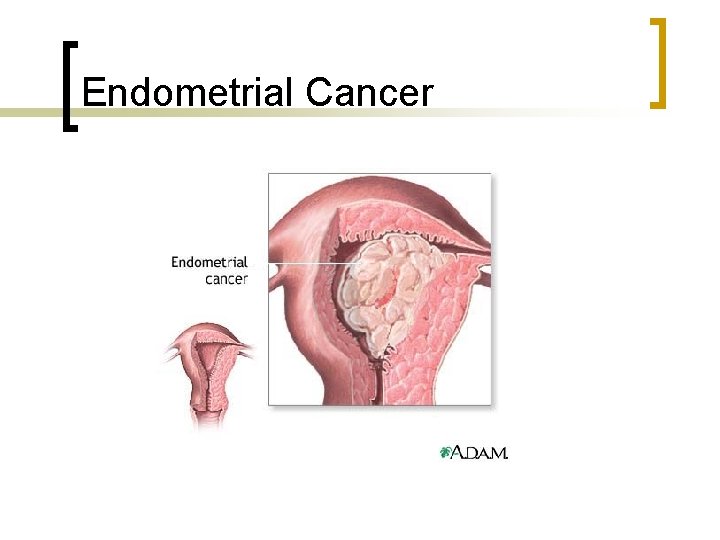 Endometrial Cancer 