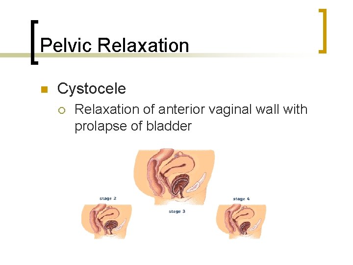 Pelvic Relaxation n Cystocele ¡ Relaxation of anterior vaginal wall with prolapse of bladder