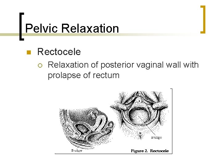Pelvic Relaxation n Rectocele ¡ Relaxation of posterior vaginal wall with prolapse of rectum